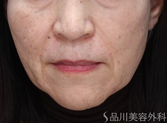 症例NO.73504のAFTER写真