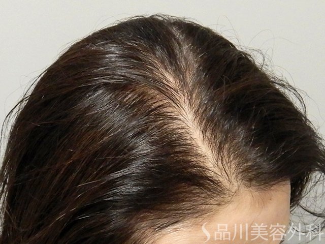 症例NO.69316のAFTER写真