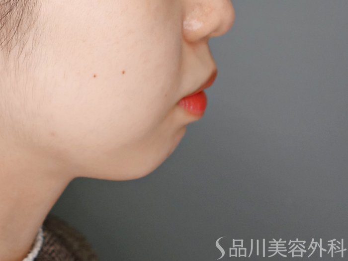 症例NO.69710のBEFORE写真