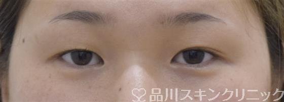 症例NO.53629のBEFORE写真
