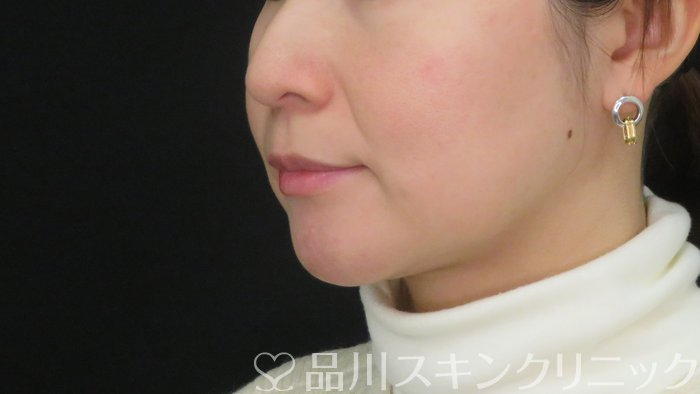 症例NO.72294のAFTER写真