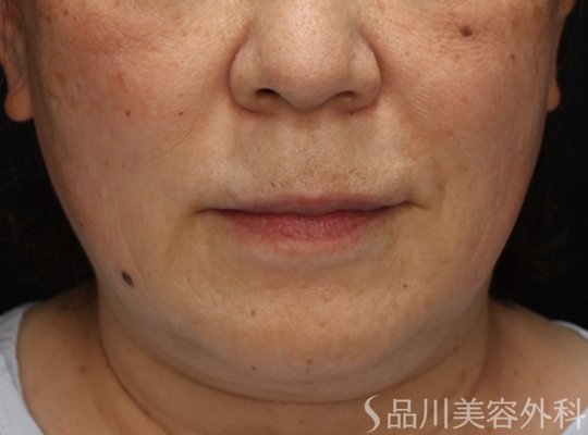 症例NO.73815のBEFORE写真