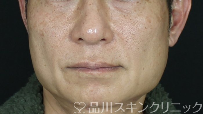 症例NO.71192のBEFORE写真
