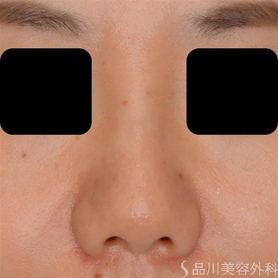 症例NO.52807のBEFORE写真