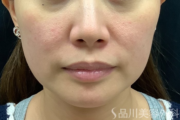 症例NO.71581のBEFORE写真
