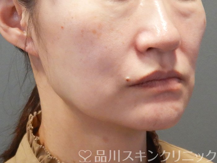 症例NO.72393のBEFORE写真