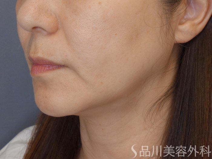 症例NO.69869のBEFORE写真