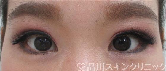 症例NO.26354のAFTER写真