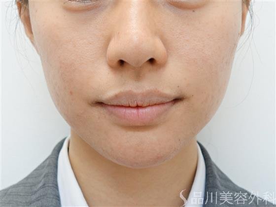 症例NO.40666のAFTER写真