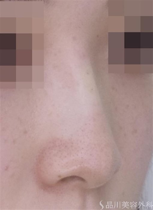 症例NO.49318のAFTER写真