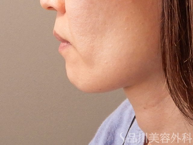 症例NO.70676のBEFORE写真