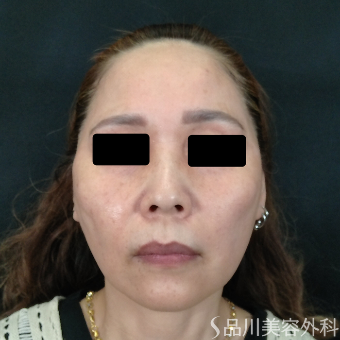 症例NO.72665のAFTER写真