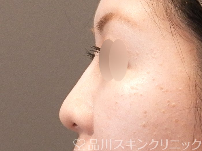 症例NO.64613のAFTER写真