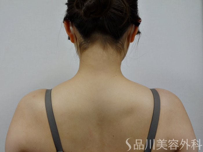 症例NO.73866のBEFORE写真