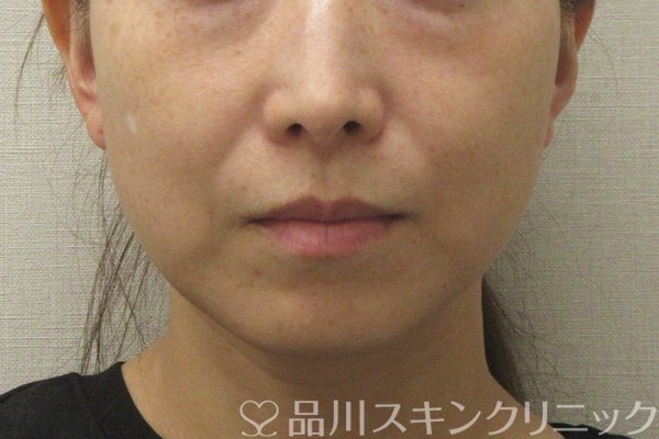 症例NO.73965のBEFORE写真