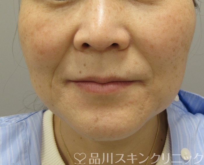 症例NO.74719のBEFORE写真