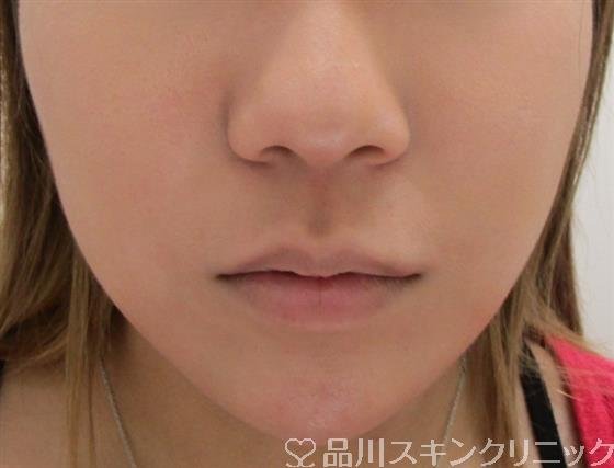 症例NO.42240のAFTER写真