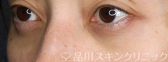 症例NO.75132のAFTER写真