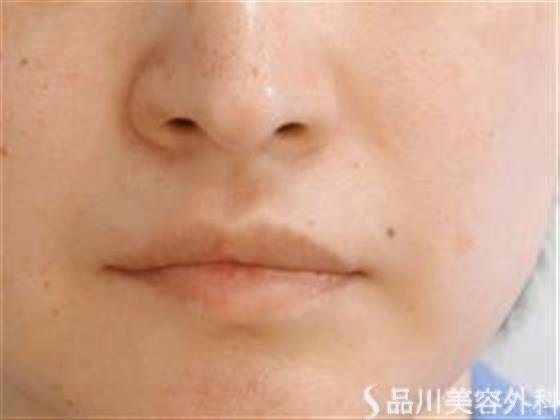 症例NO.35308のAFTER写真