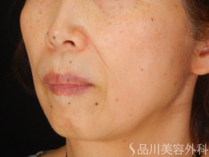 症例NO.68157のBEFORE写真