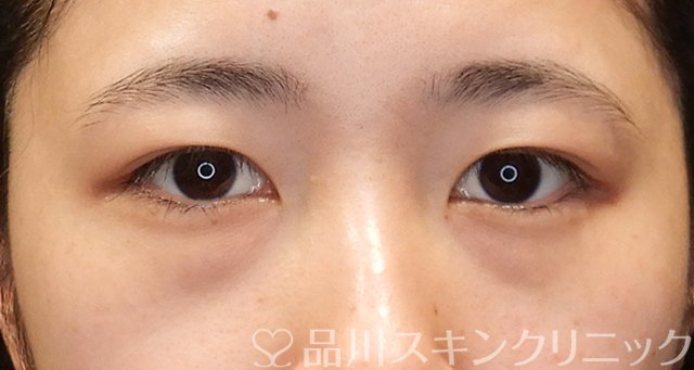 症例NO.75057のBEFORE写真