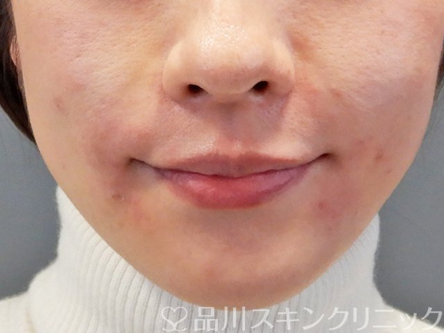 症例NO.69626のAFTER写真