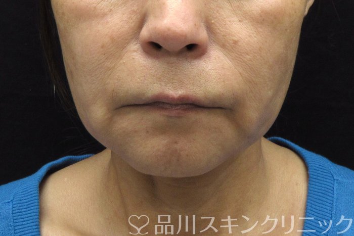 症例NO.74388のBEFORE写真