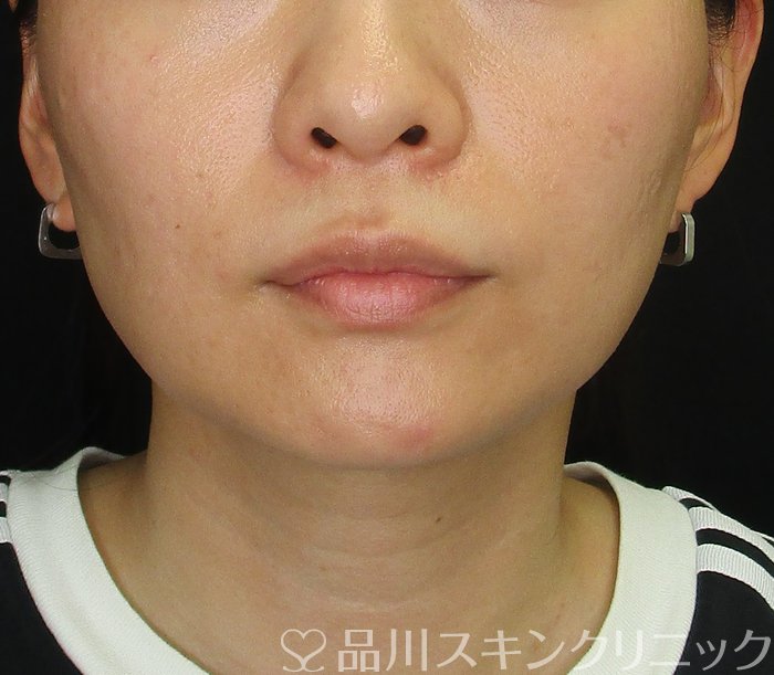 症例NO.72867のBEFORE写真