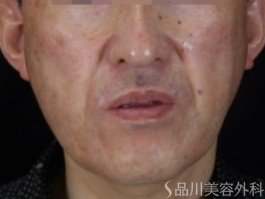 症例NO.70903のBEFORE写真