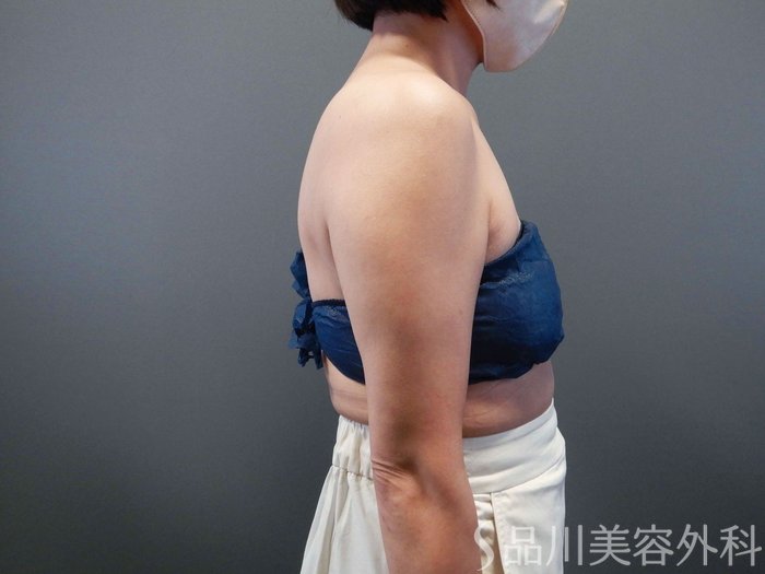 症例NO.65681のBEFORE写真