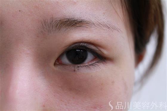 症例NO.20585のBEFORE写真