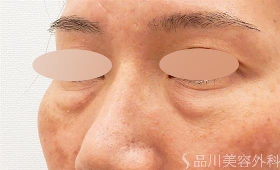 症例NO.61308のBEFORE写真