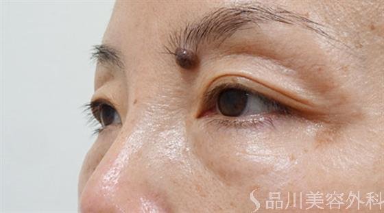 症例NO.50761のBEFORE写真