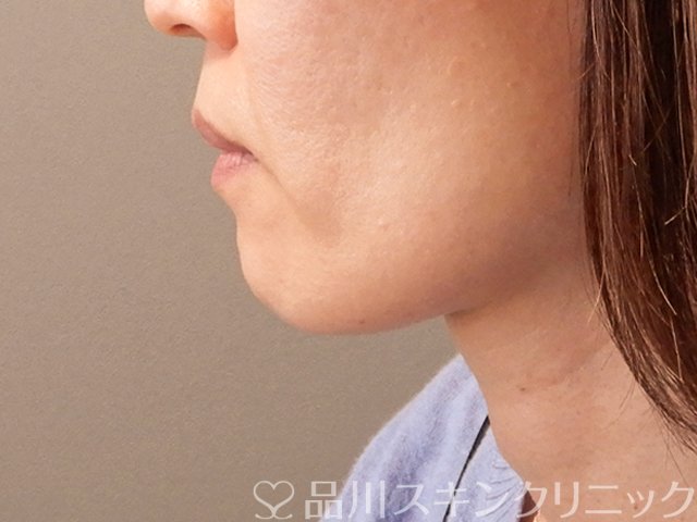 症例NO.70676のBEFORE写真
