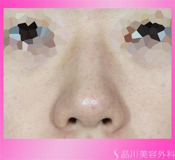 症例NO.54279のBEFORE写真