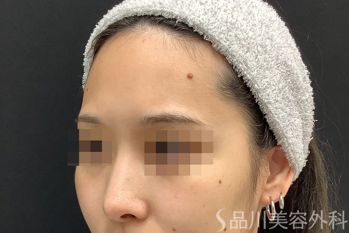 症例NO.67784のBEFORE写真