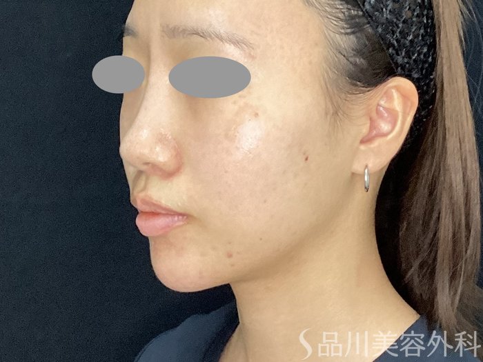 症例NO.71827のAFTER写真