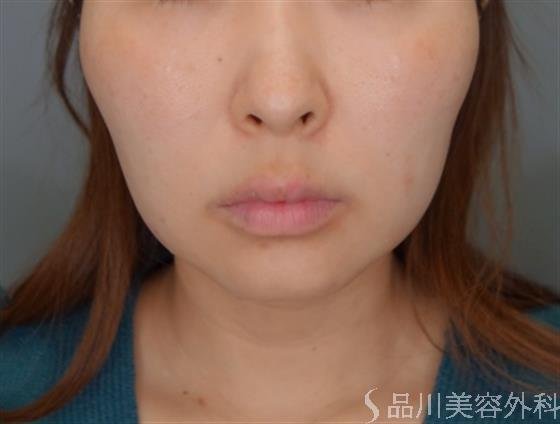 症例NO.54526のBEFORE写真