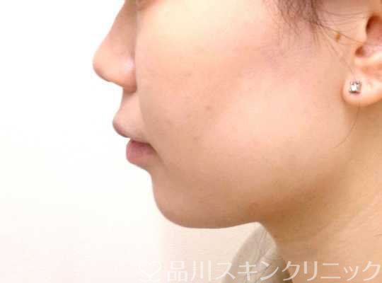 症例NO.69194のBEFORE写真