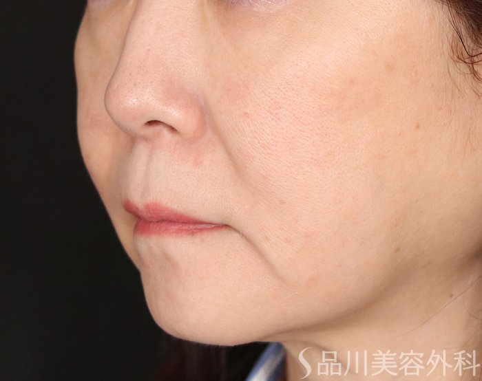 症例NO.70906のBEFORE写真