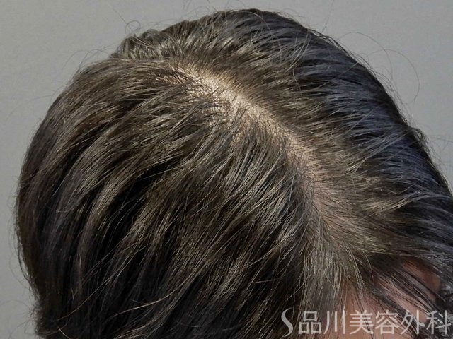 症例NO.69315のBEFORE写真