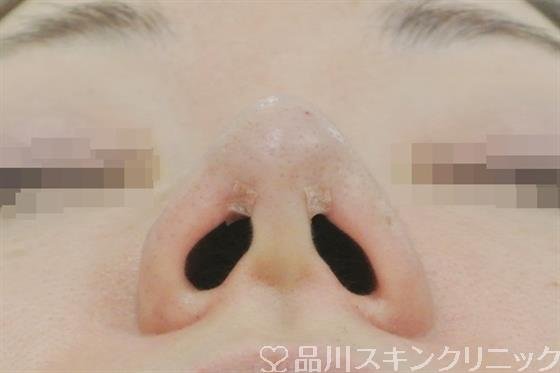 症例NO.29609のAFTER写真