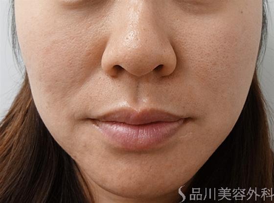症例NO.13789のBEFORE写真