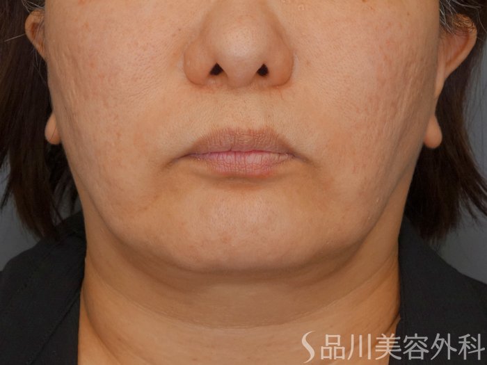 症例NO.70051のBEFORE写真