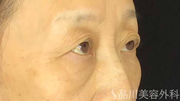 症例NO.69494のBEFORE写真