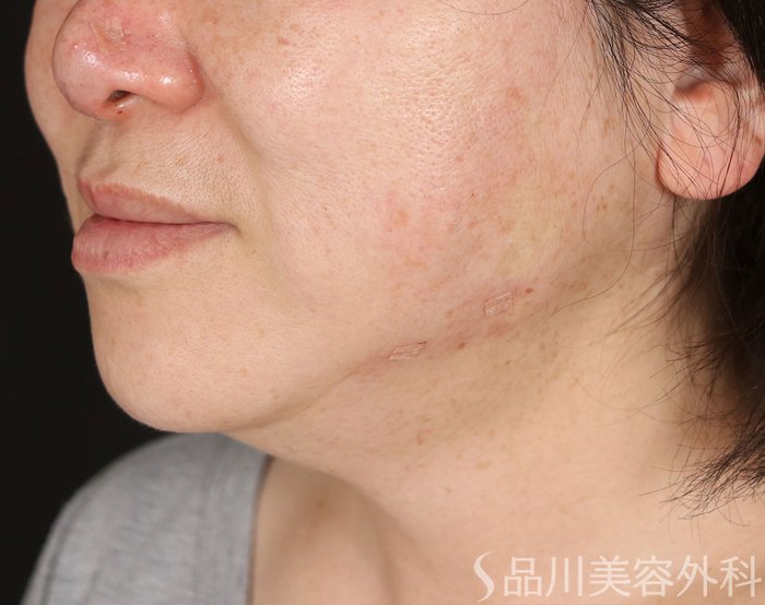 症例NO.73730のAFTER写真