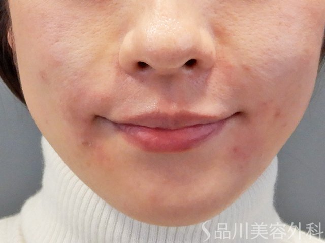 症例NO.69626のAFTER写真