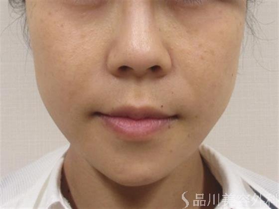 症例NO.36524のAFTER写真