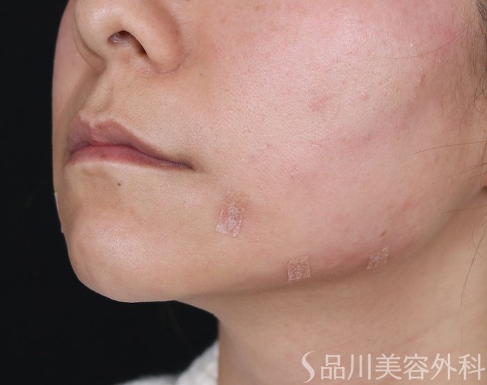 症例NO.71893のAFTER写真