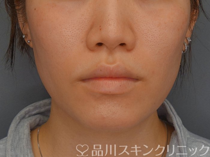 症例NO.74136のBEFORE写真